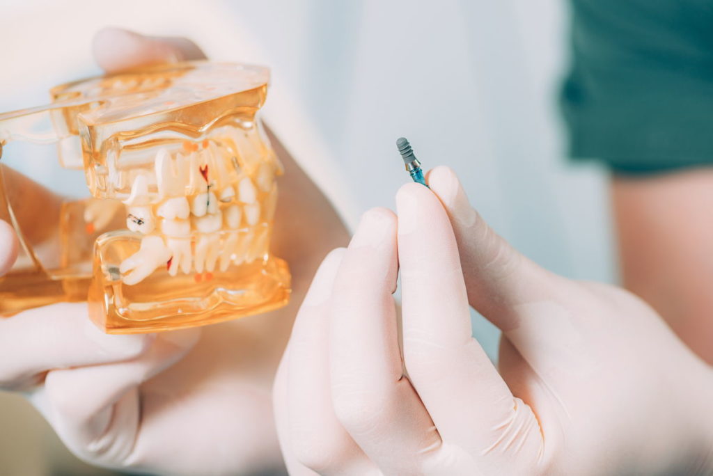 dentist-holding-dental-implant
