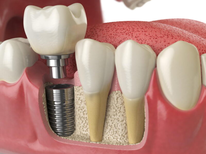 The Benefits of Dental Implants