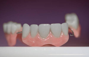 Dental Bridge