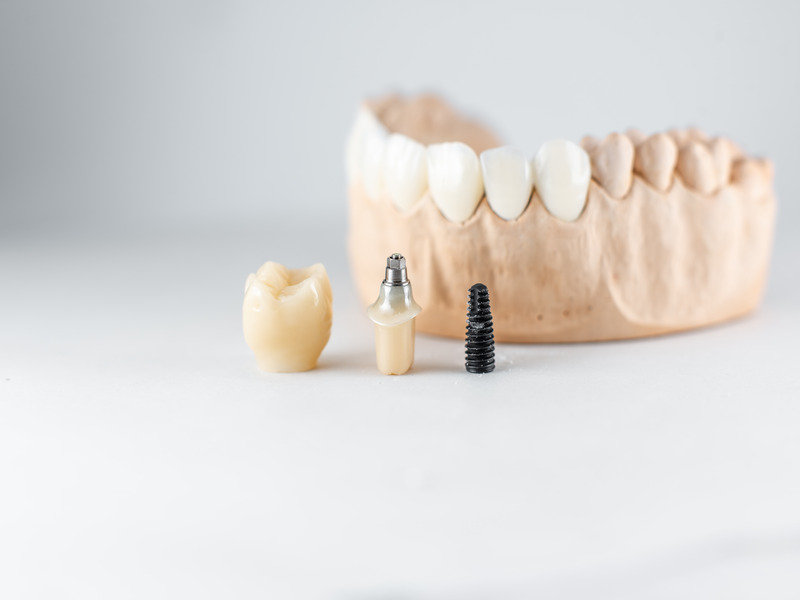 Do I Need Dental Implants?