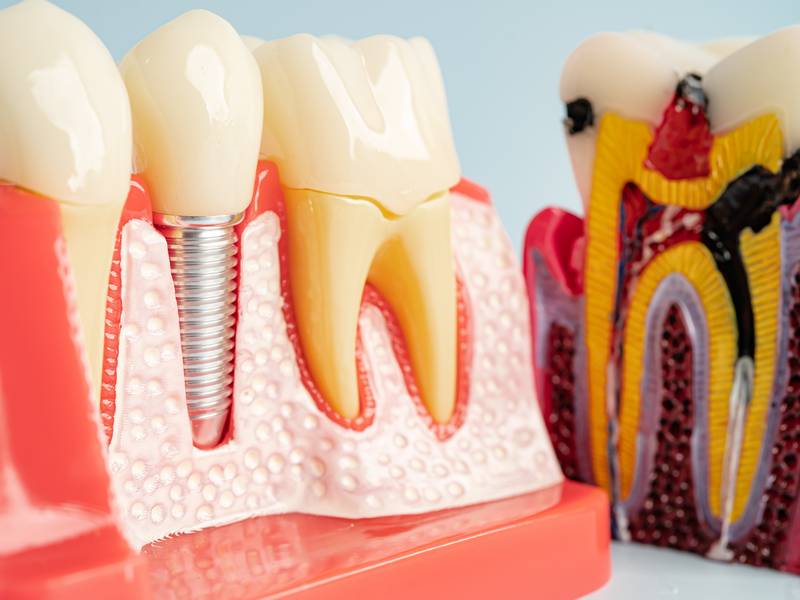 What Are Dental Implants and How Do They Work?