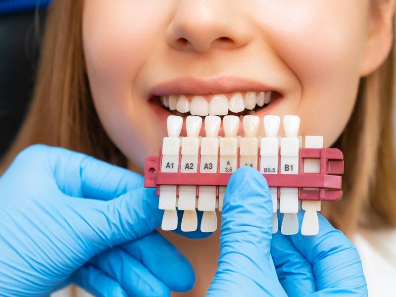 What Are The Benefits Of Choosing Professionals For Teeth Whitening?