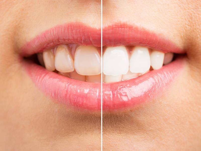 Dental Implants: What Should I Know About This Procedure?