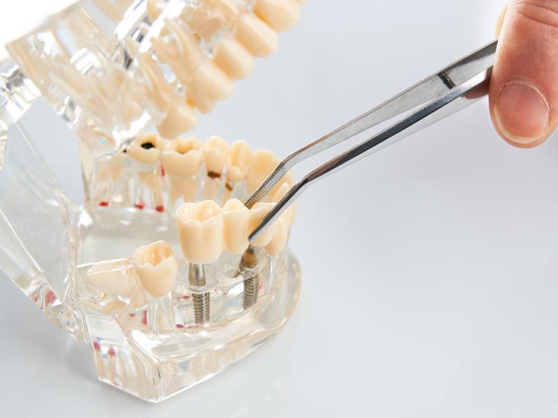 What Can I Expect When Getting a Dental Bridge in Dexter, MI?