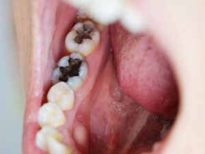 What Happens If a Cavity is Left Untreated?