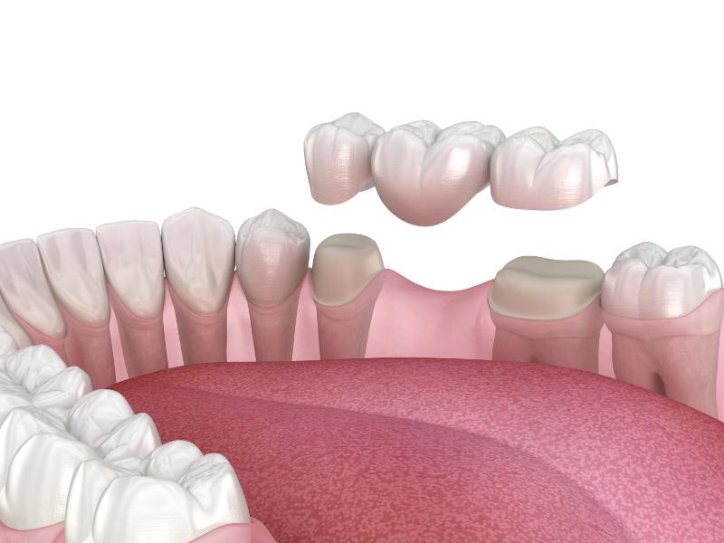 How Should I Care for My Dental Bridge?
