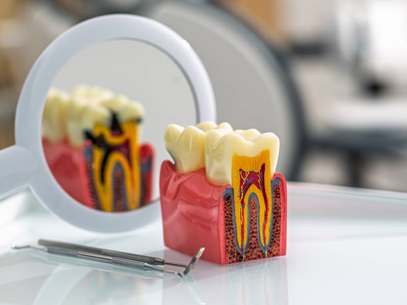 Amalgam vs. Composite: What Is The Best Filling for Your Cavity? | AH ...