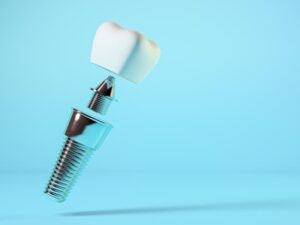 Home 4 Do Dental Implants Look and Feel Like Natural Teeth?