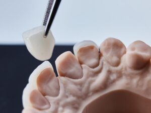 Will My Natural Teeth Need to Be Shaved Down for Veneers?
