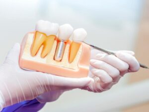 What To Expect After Getting Professional Dental Implants?