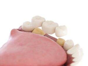 Will a Dental Bridge Affect My Speech or Eating Habits?