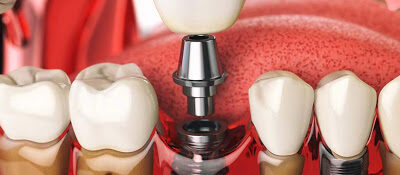 dental implants