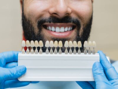 How Long Do Veneers Last?