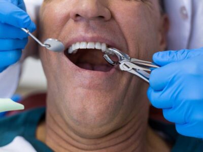 Can an Emergency Dentist Extract a Tooth?