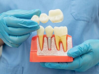 Why Choose a Dental Bridge to Replace Missing Teeth?