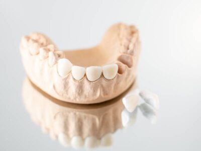 How Does A Dental Bridge Improve My Oral Health?