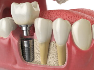 The Benefits of Dental Implants